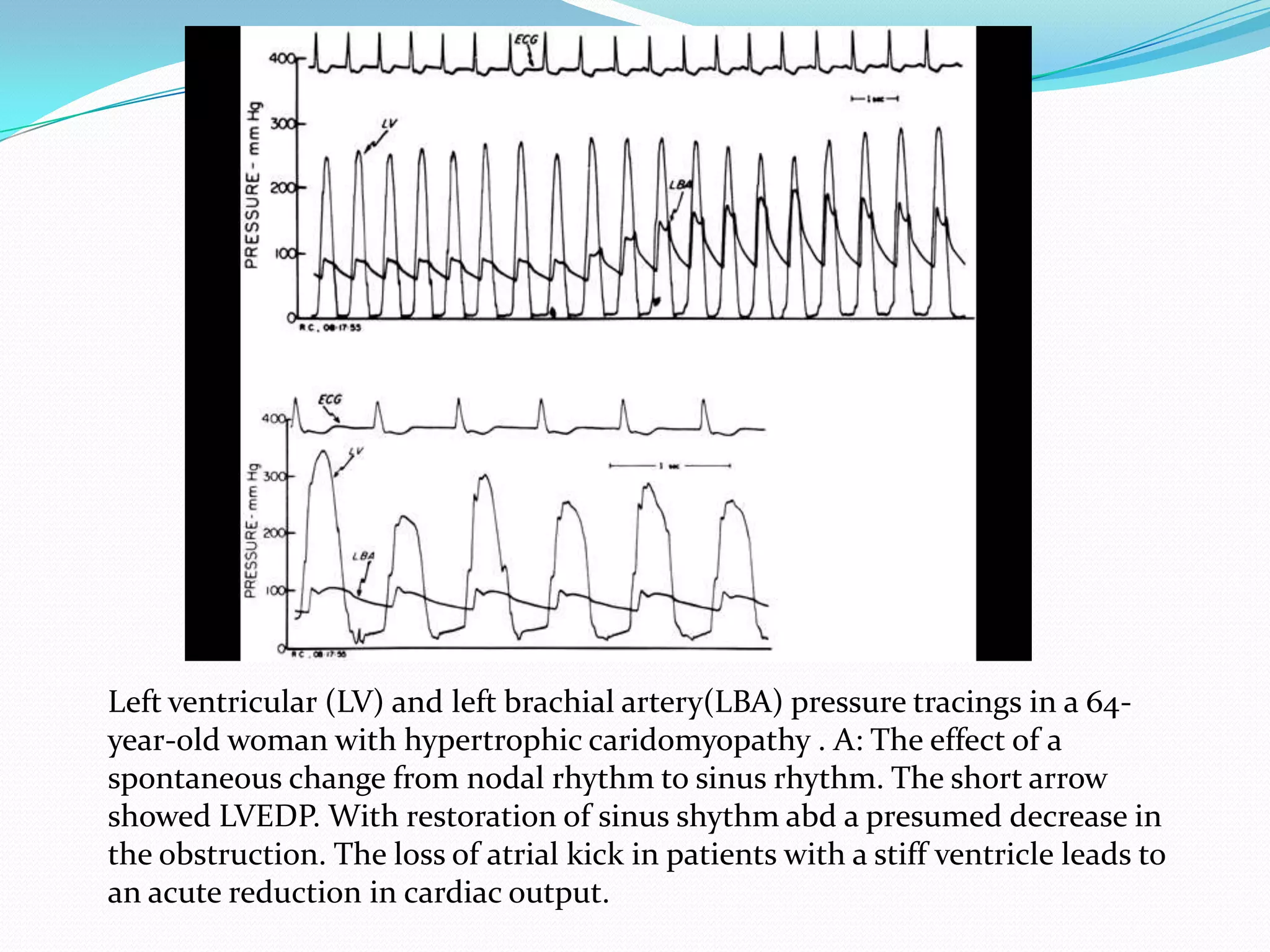 Left ventricular (LV) and left brachial artery(LBA) pressure tracings in a 64year-old woman with hypertrophic caridomyopathy . A: The effect of a
spontaneous change from nodal rhythm to sinus rhythm. The short arrow
showed LVEDP. With restoration of sinus shythm abd a presumed decrease in
the obstruction. The loss of atrial kick in patients with a stiff ventricle leads to
an acute reduction in cardiac output.

 