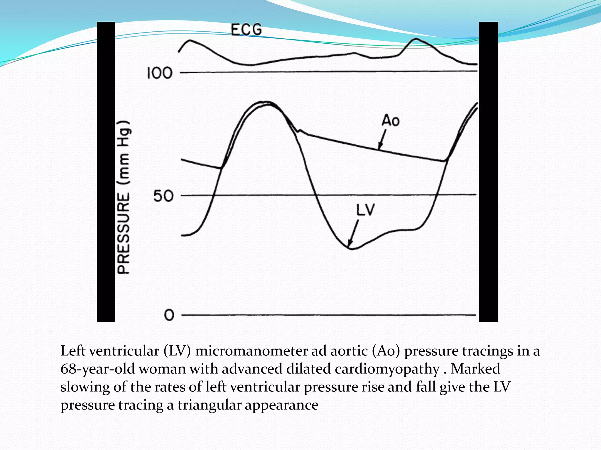Left ventricular (LV) micromanometer ad aortic (Ao) pressure tracings in a
68-year-old woman with advanced dilated cardiomyopathy . Marked
slowing of the rates of left ventricular pressure rise and fall give the LV
pressure tracing a triangular appearance

 