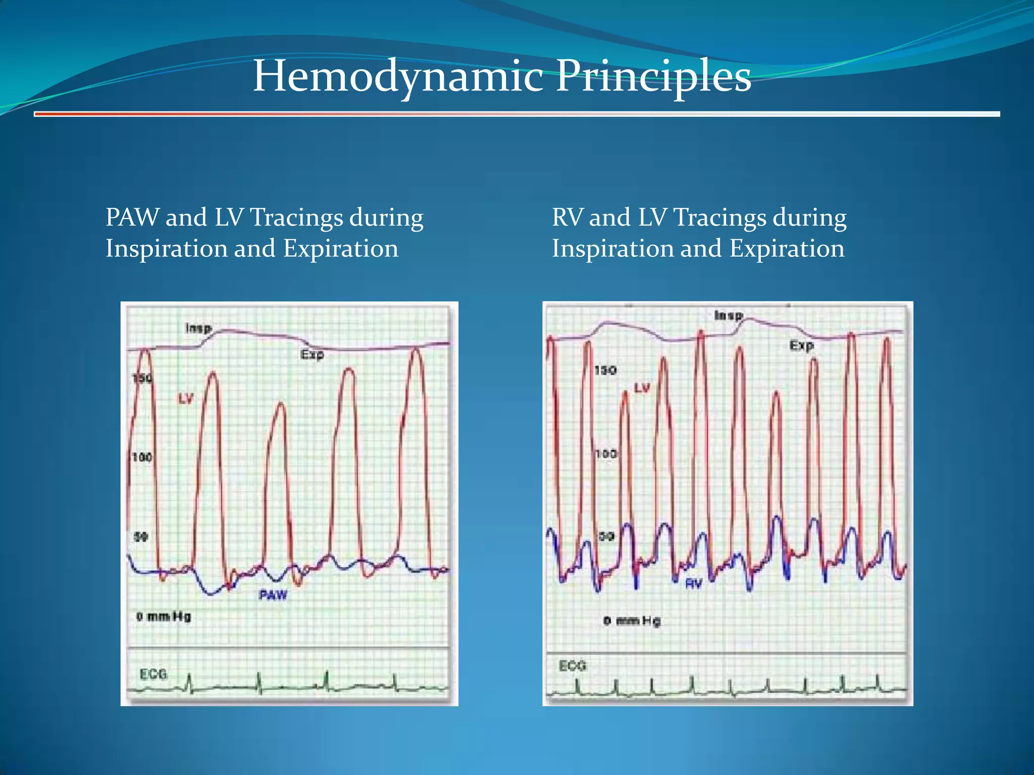 Hemodynamic Principles
PAW and LV Tracings during
Inspiration and Expiration

RV and LV Tracings during
Inspiration and Expiration

 