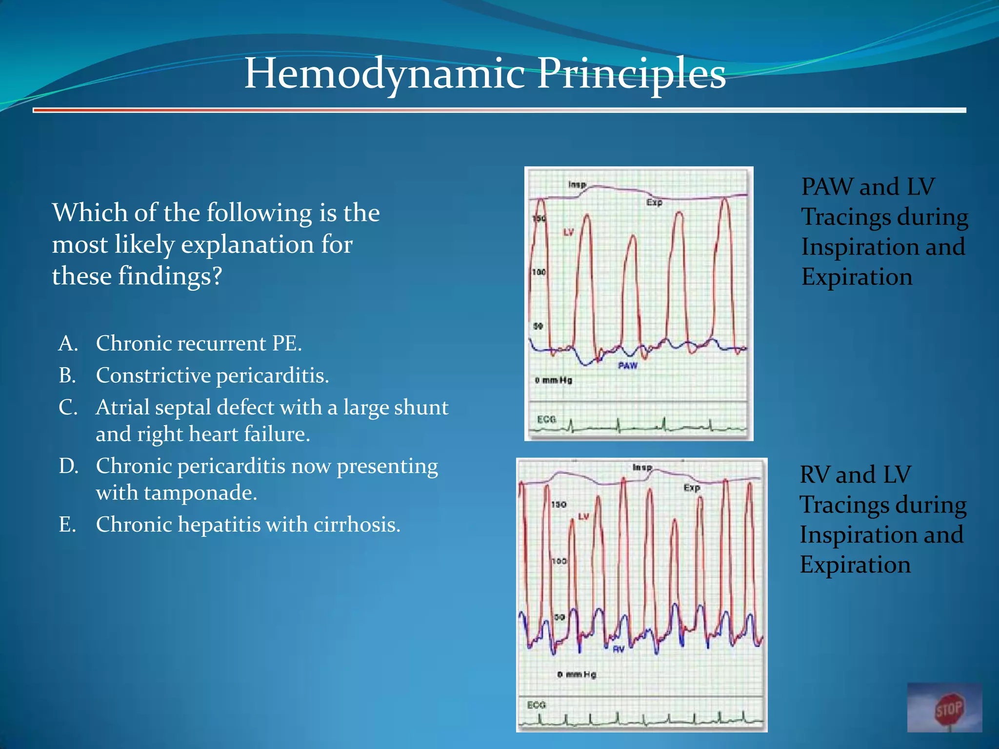 Hemodynamic Principles
Which of the following is the
most likely explanation for
these findings?
A. Chronic recurrent PE.
B. Constrictive pericarditis.
C. Atrial septal defect with a large shunt
and right heart failure.
D. Chronic pericarditis now presenting
with tamponade.
E. Chronic hepatitis with cirrhosis.

PAW and LV
Tracings during
Inspiration and
Expiration

RV and LV
Tracings during
Inspiration and
Expiration

 
