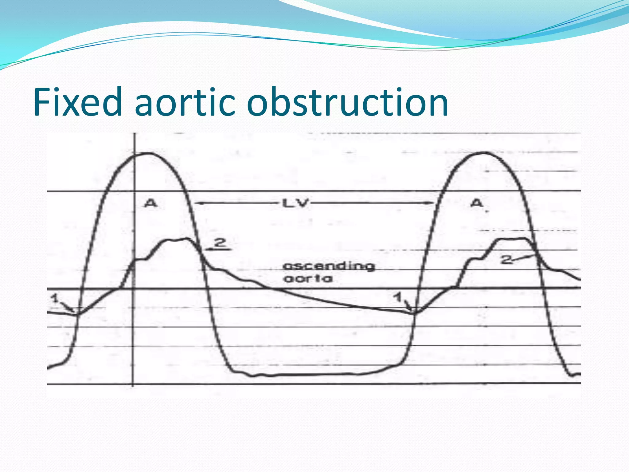 Fixed aortic obstruction

 