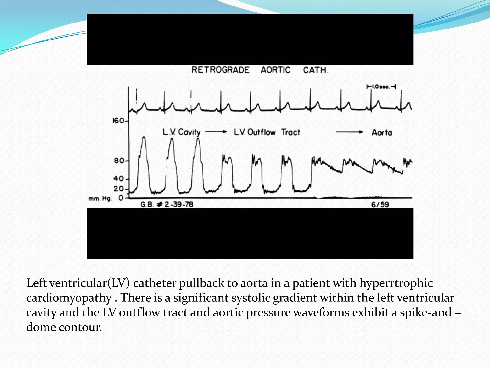Left ventricular(LV) catheter pullback to aorta in a patient with hyperrtrophic
cardiomyopathy . There is a significant systolic gradient within the left ventricular
cavity and the LV outflow tract and aortic pressure waveforms exhibit a spike-and –
dome contour.

 