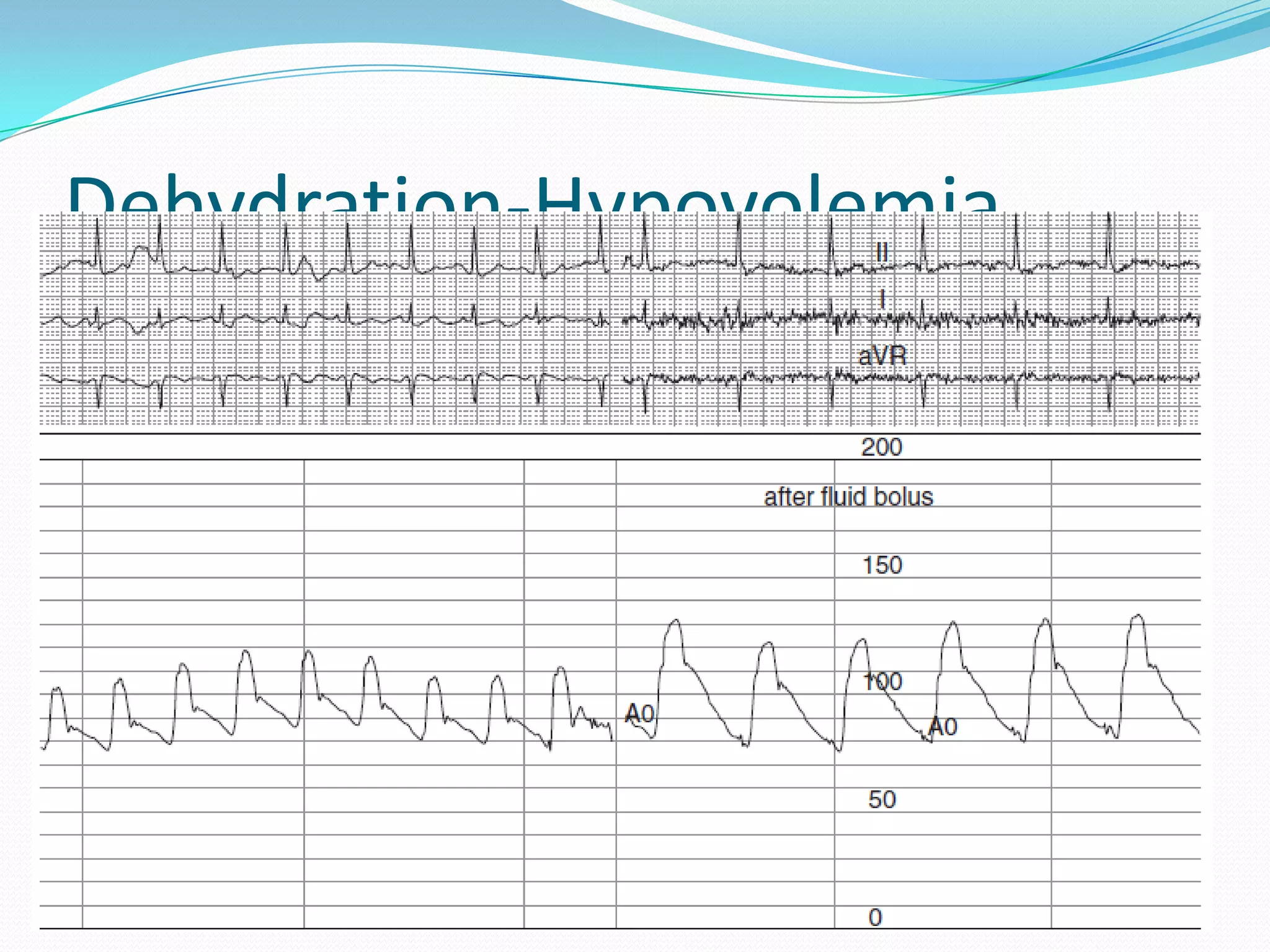 Dehydration-Hypovolemia

 