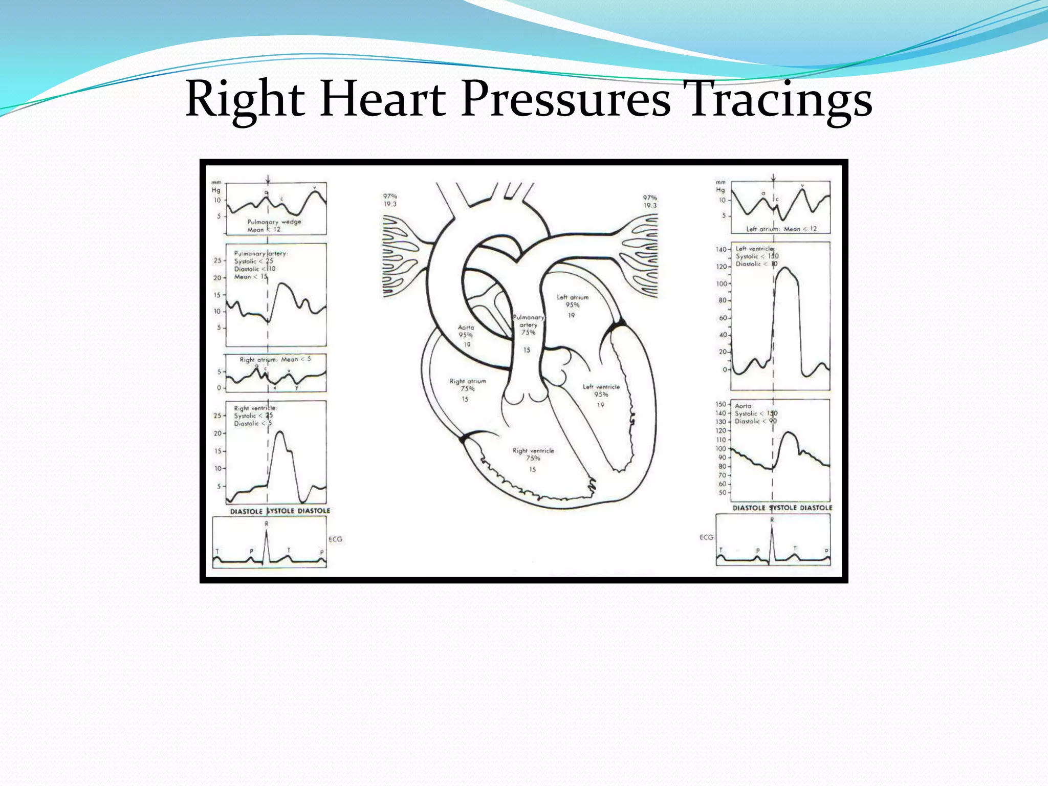 Right Heart Pressures Tracings

 