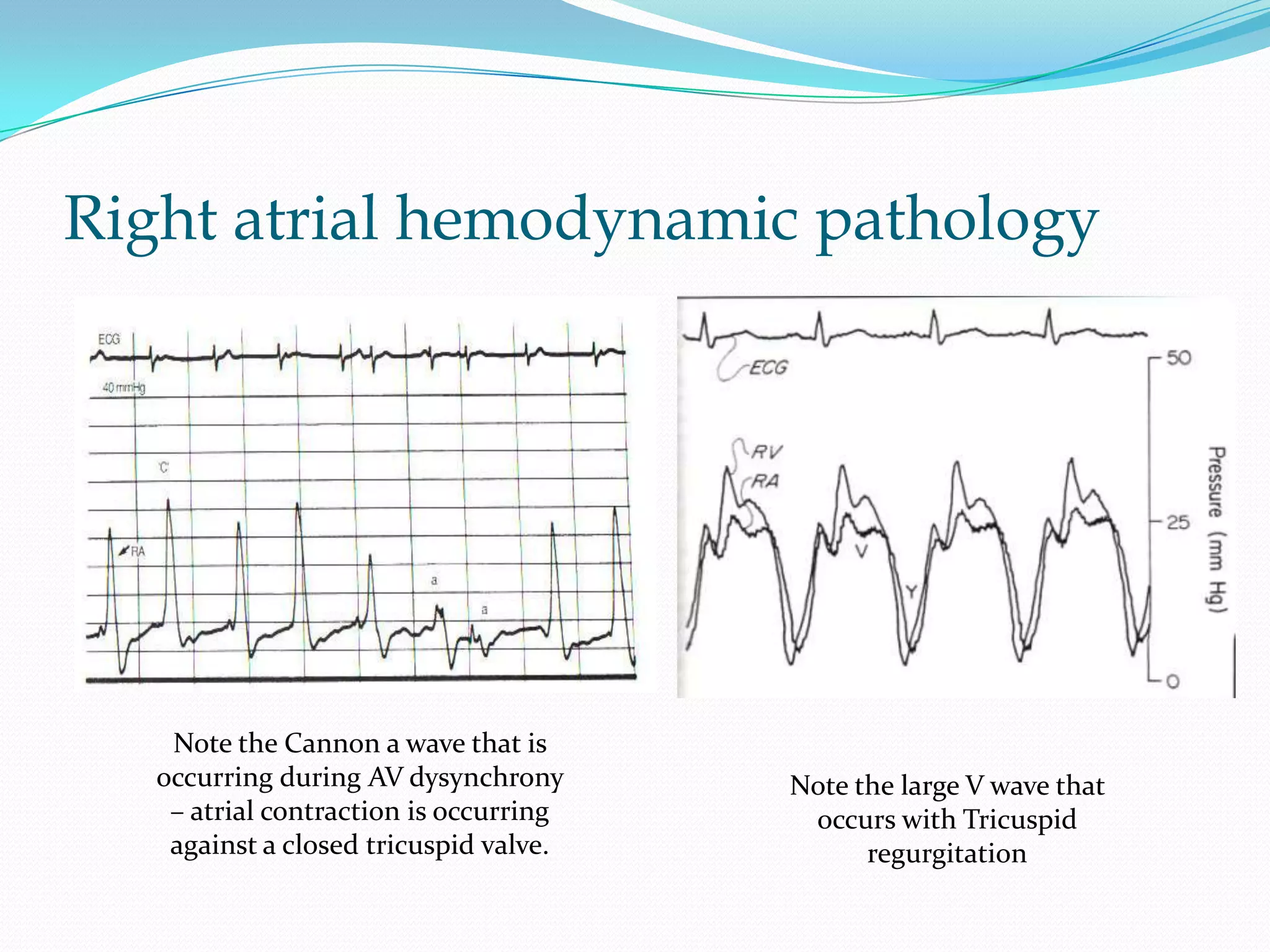 Right atrial hemodynamic pathology

Note the Cannon a wave that is
occurring during AV dysynchrony
– atrial contraction is occurring
against a closed tricuspid valve.

Note the large V wave that
occurs with Tricuspid
regurgitation

 