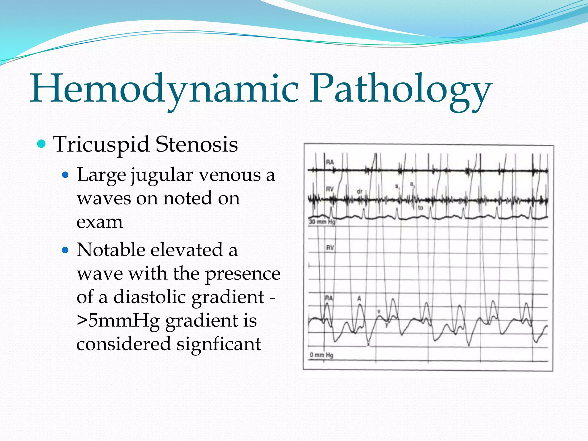 Hemodynamic Pathology
 Tricuspid Stenosis
 Large jugular venous a

waves on noted on
exam
 Notable elevated a
wave with the presence
of a diastolic gradient >5mmHg gradient is
considered signficant

 