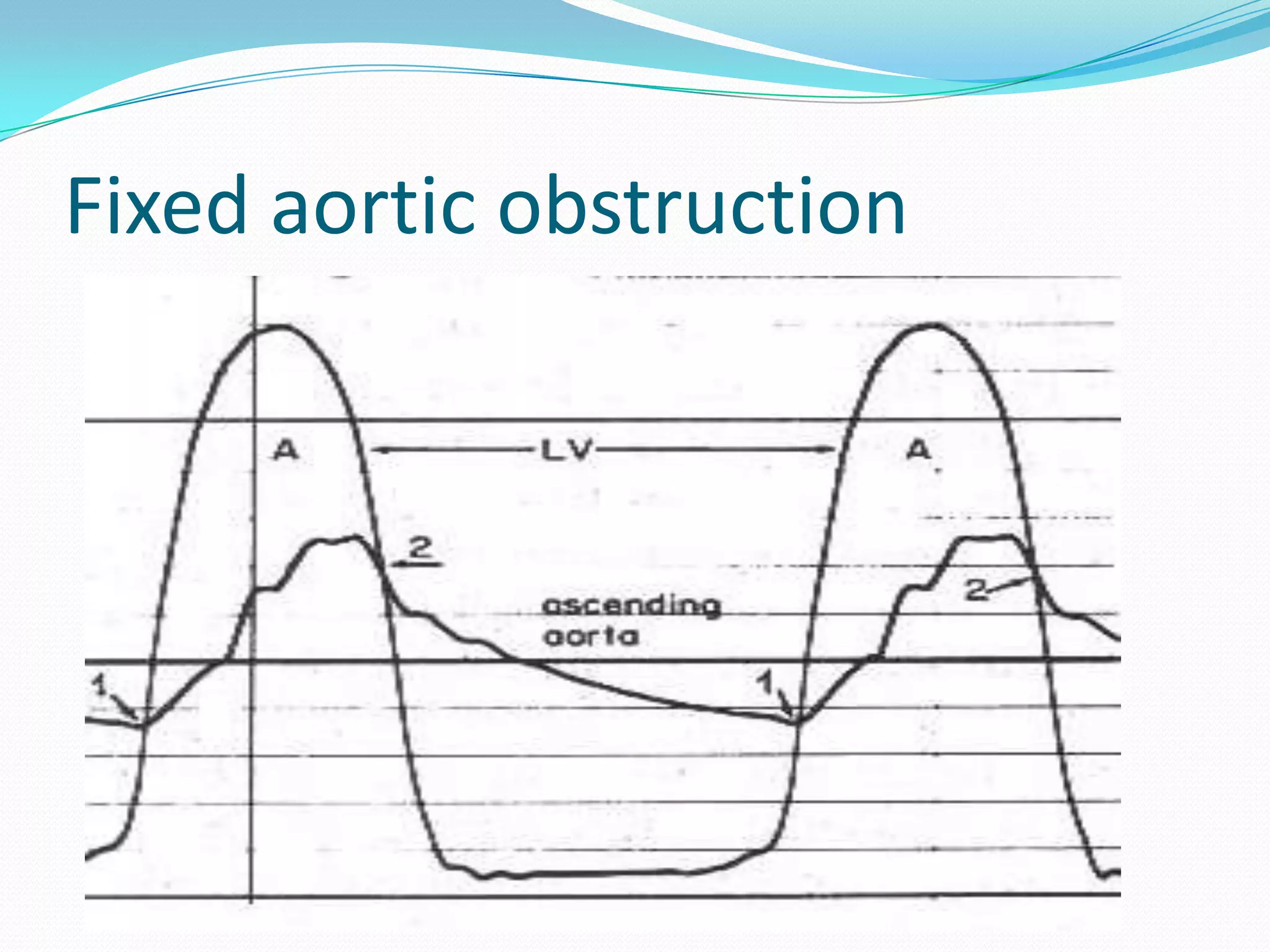 Fixed aortic obstruction

 