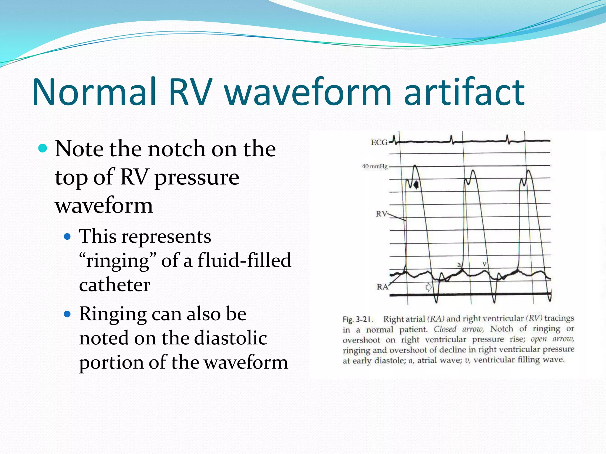Normal RV waveform artifact
 Note the notch on the
top of RV pressure
waveform
 This represents

“ringing” of a fluid-filled
catheter
 Ringing can also be
noted on the diastolic
portion of the waveform

 
