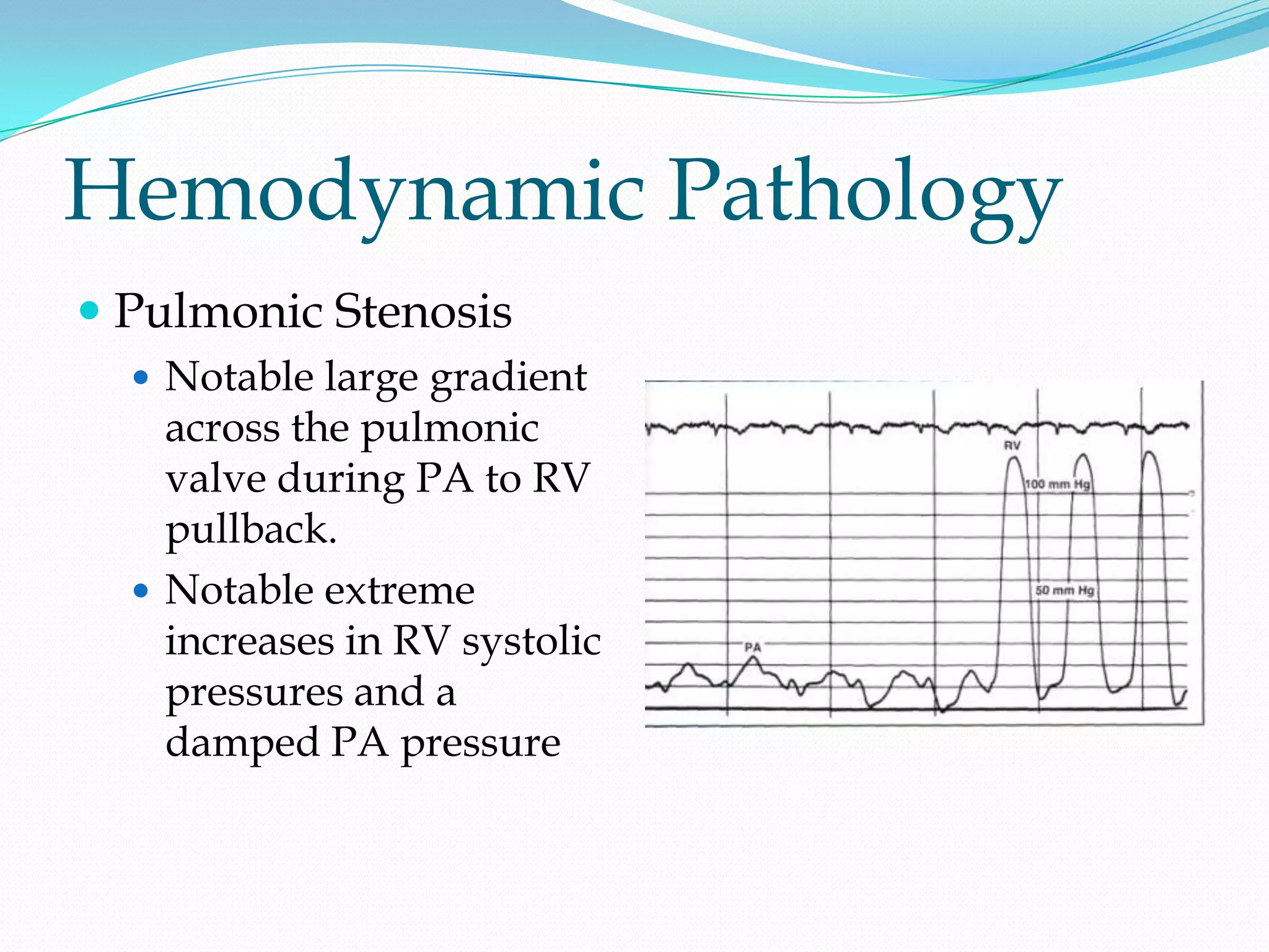 Hemodynamic Pathology
 Pulmonic Stenosis
 Notable large gradient

across the pulmonic
valve during PA to RV
pullback.
 Notable extreme
increases in RV systolic
pressures and a
damped PA pressure

 