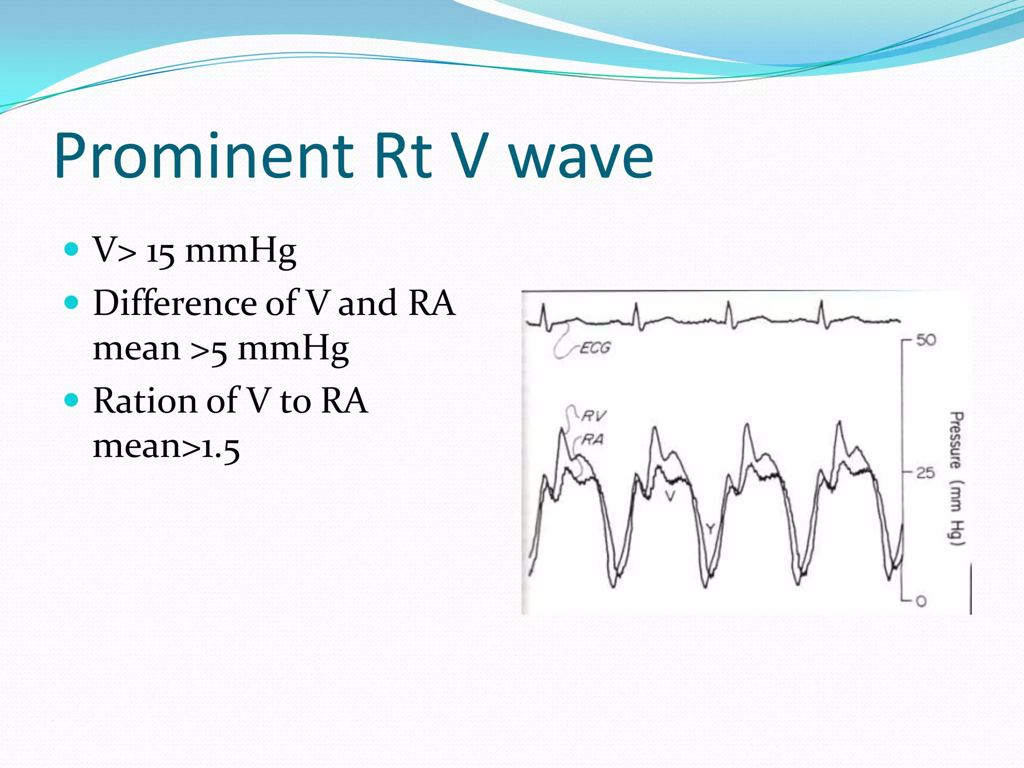 Prominent Rt V wave
 V> 15 mmHg
 Difference of V and RA

mean >5 mmHg
 Ration of V to RA
mean>1.5

 