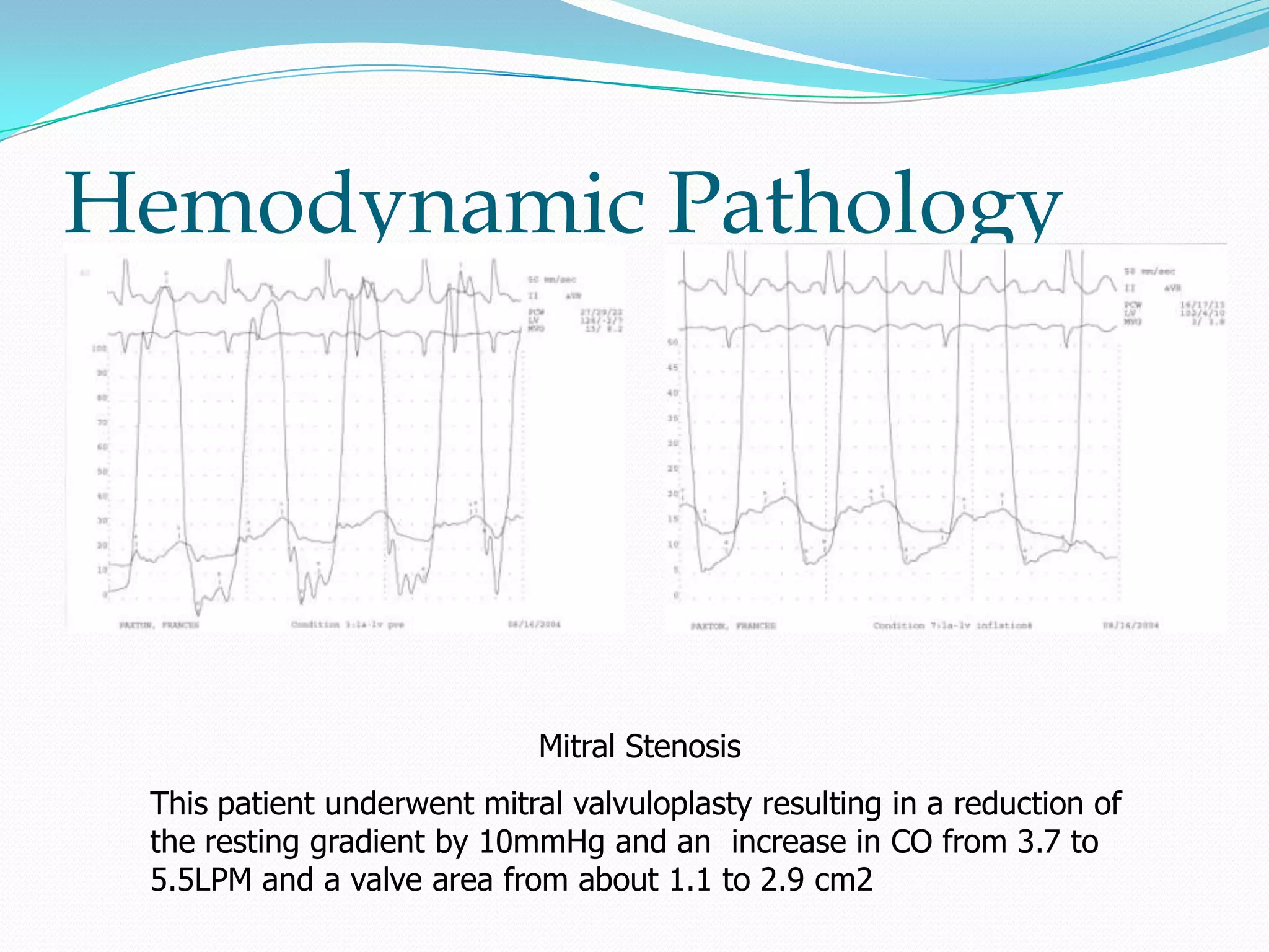 Hemodynamic Pathology

Mitral Stenosis
This patient underwent mitral valvuloplasty resulting in a reduction of
the resting gradient by 10mmHg and an increase in CO from 3.7 to
5.5LPM and a valve area from about 1.1 to 2.9 cm2

 