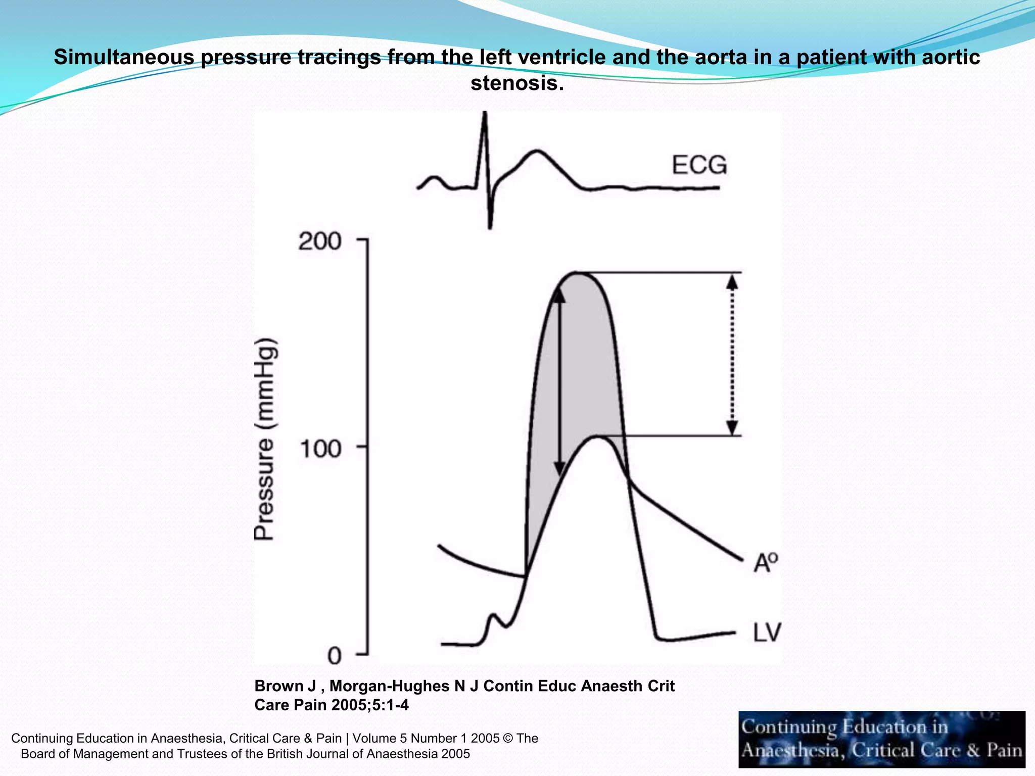 Simultaneous pressure tracings from the left ventricle and the aorta in a patient with aortic
stenosis.

Brown J , Morgan-Hughes N J Contin Educ Anaesth Crit
Care Pain 2005;5:1-4
Continuing Education in Anaesthesia, Critical Care & Pain | Volume 5 Number 1 2005 © The
Board of Management and Trustees of the British Journal of Anaesthesia 2005

 