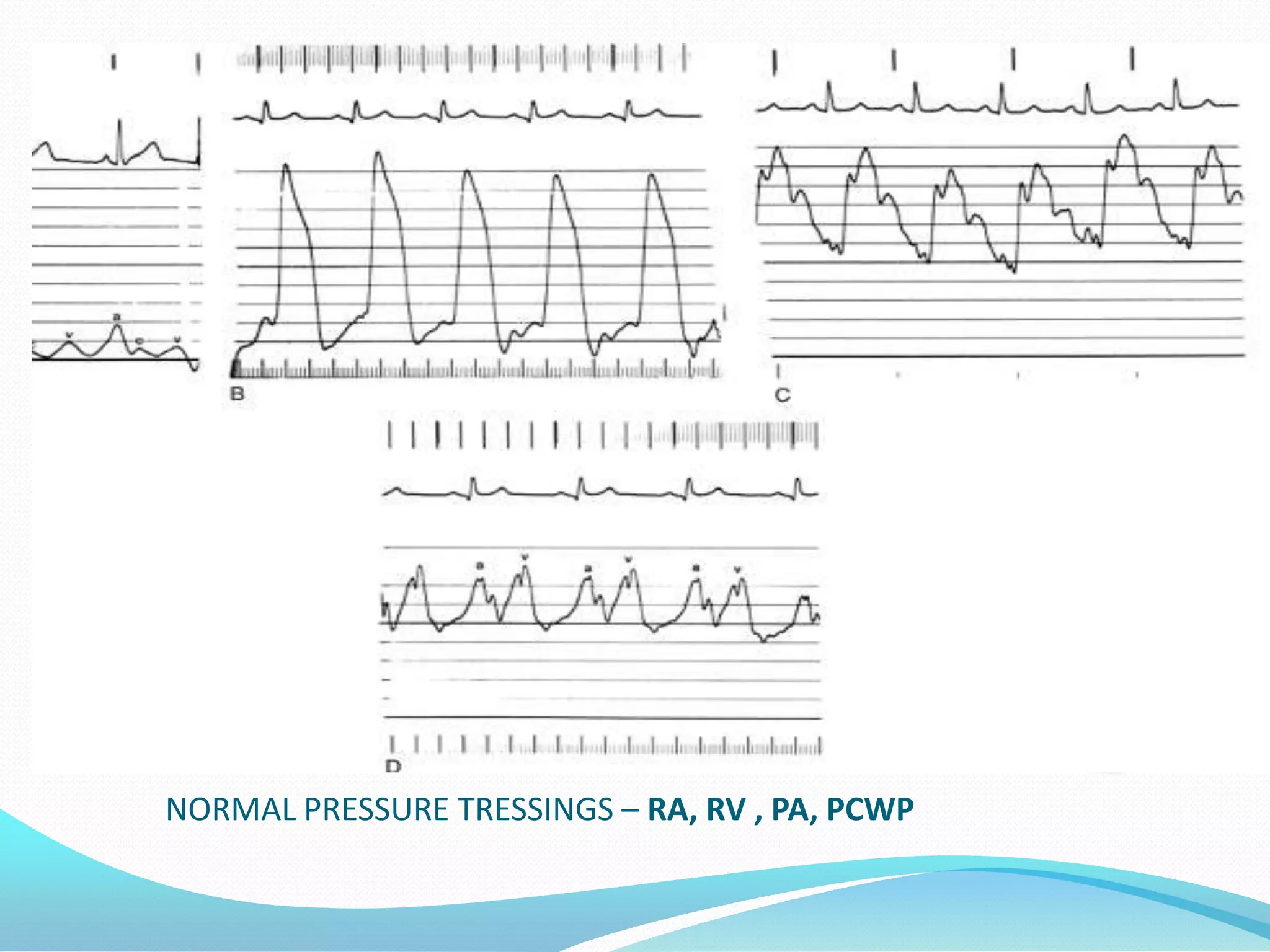 NORMAL PRESSURE TRESSINGS – RA, RV , PA, PCWP

 