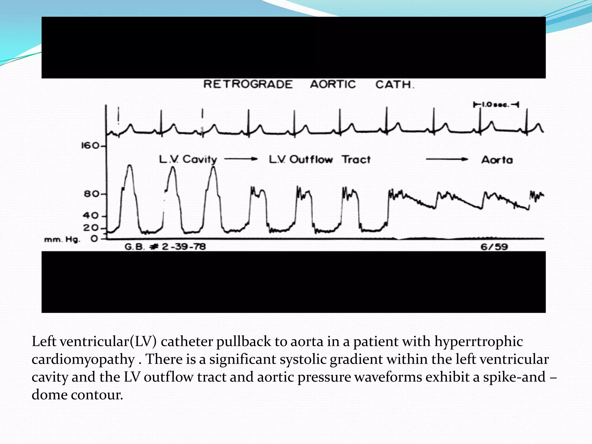 Left ventricular(LV) catheter pullback to aorta in a patient with hyperrtrophic
cardiomyopathy . There is a significant systolic gradient within the left ventricular
cavity and the LV outflow tract and aortic pressure waveforms exhibit a spike-and –
dome contour.

 