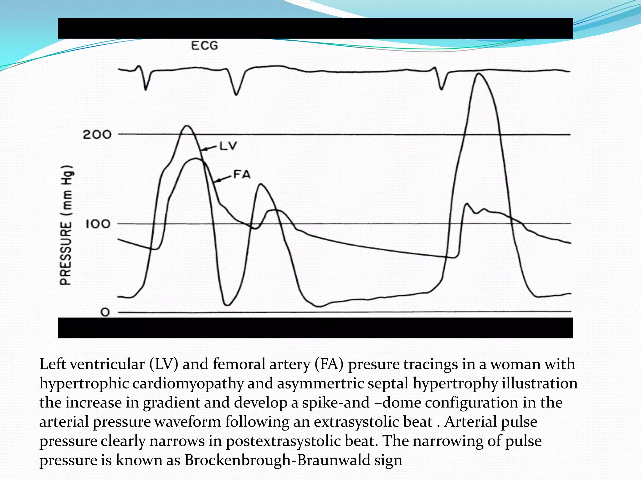 Left ventricular (LV) and femoral artery (FA) presure tracings in a woman with
hypertrophic cardiomyopathy and asymmertric septal hypertrophy illustration
the increase in gradient and develop a spike-and –dome configuration in the
arterial pressure waveform following an extrasystolic beat . Arterial pulse
pressure clearly narrows in postextrasystolic beat. The narrowing of pulse
pressure is known as Brockenbrough-Braunwald sign

 