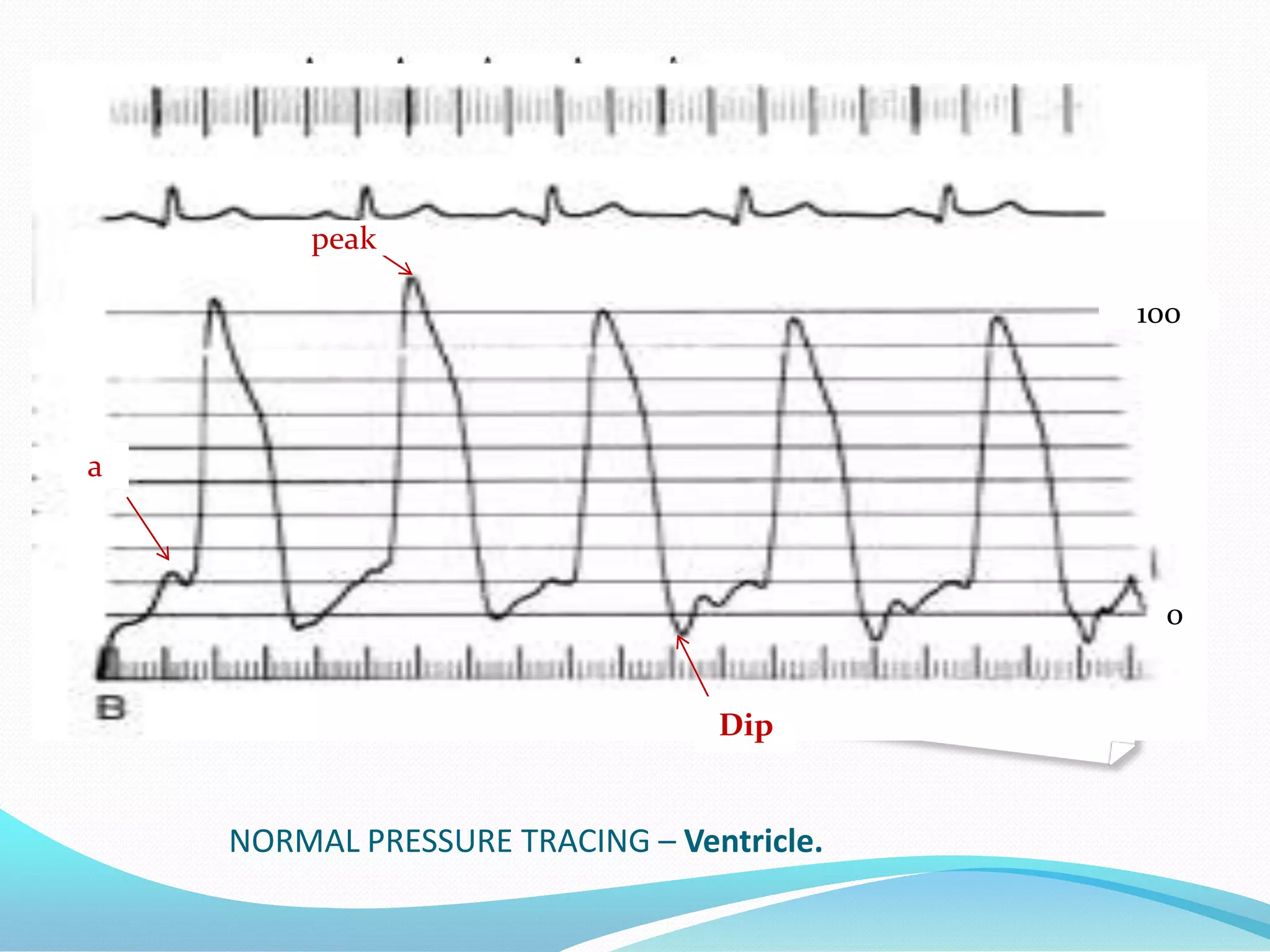 peak

100

a

0
Dip

NORMAL PRESSURE TRACING – Ventricle.

 