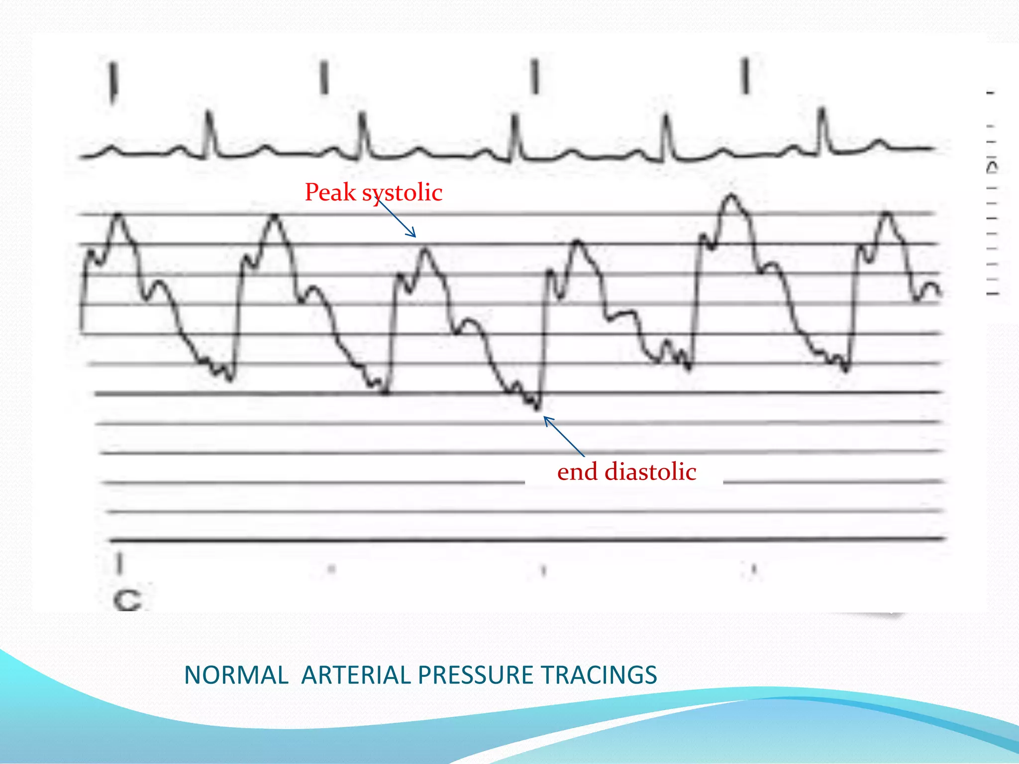 Peak systolic

end diastolic

NORMAL ARTERIAL PRESSURE TRACINGS

 