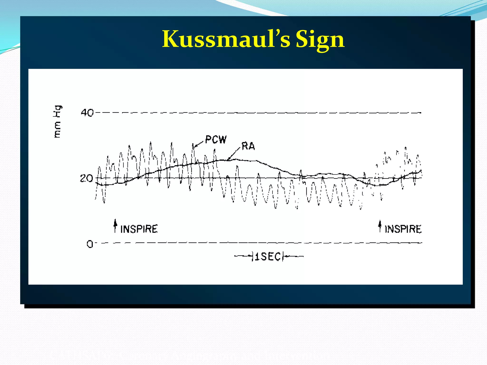 Kussmaul’s Sign

CATHSAP6: Coronary Angiography and Intervention

 