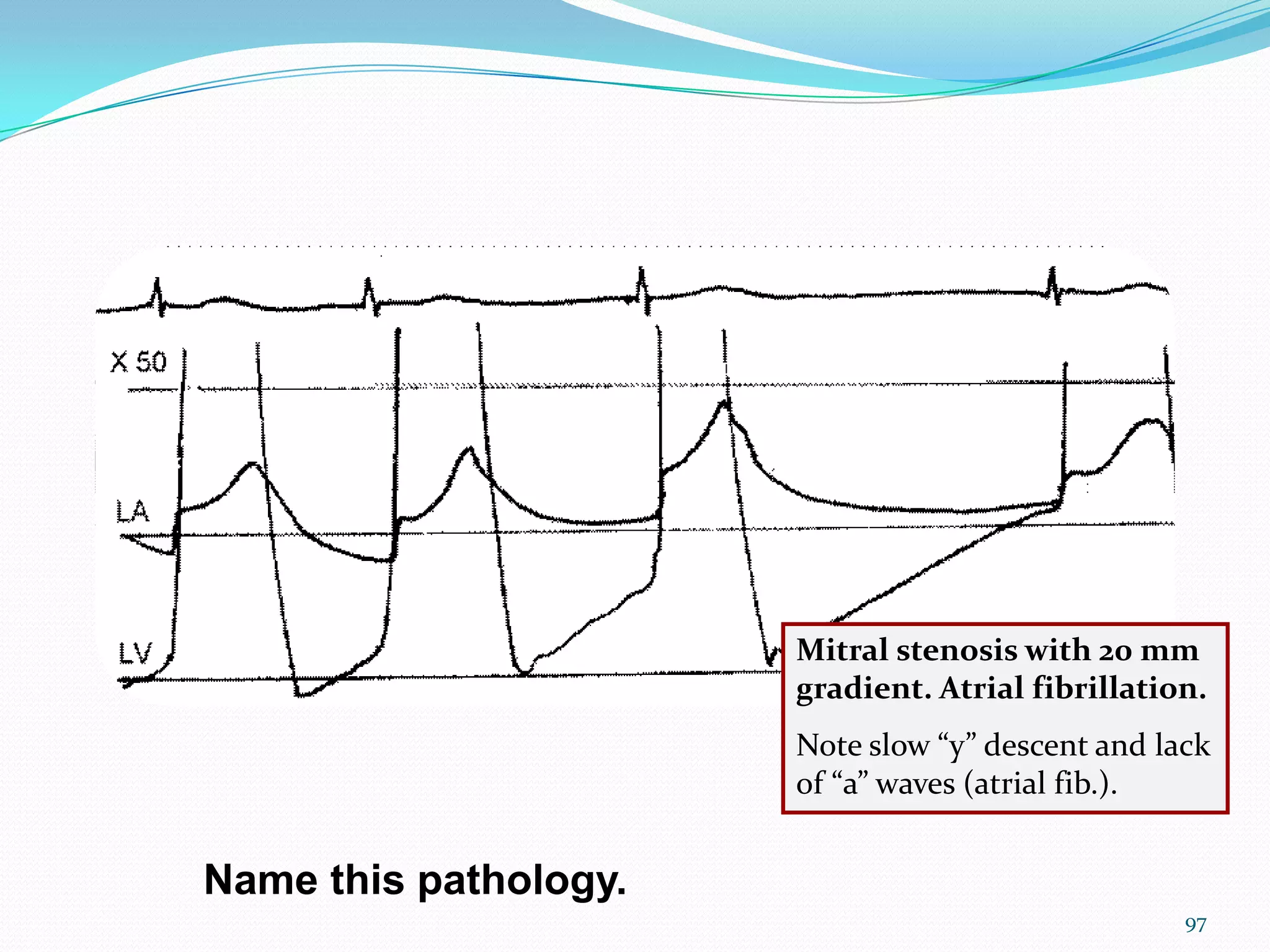 Mitral stenosis with 20 mm
gradient. Atrial fibrillation.
Note slow “y” descent and lack
of “a” waves (atrial fib.).

Name this pathology.
97

 