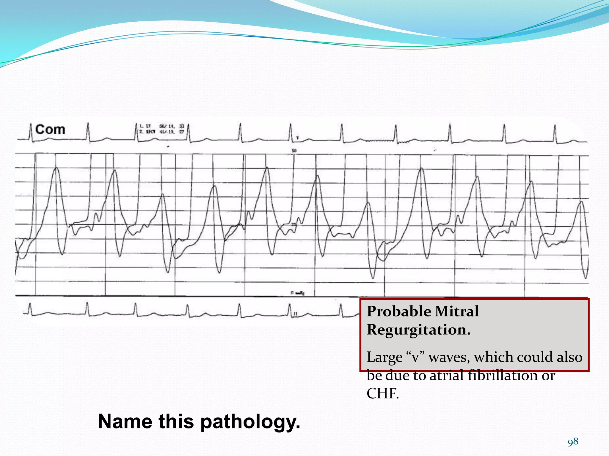 Probable Mitral
Regurgitation.
Large “v” waves, which could also
be due to atrial fibrillation or
CHF.

Name this pathology.
98

 