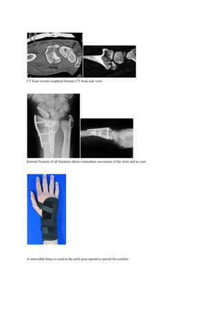 CT Scan reveals scaphoid fracture CT Scan side view
Internal fixation of all fractures allows immediate movement of the wrist and no cast
A removable brace is used in the early post-operative period for comfort.
 