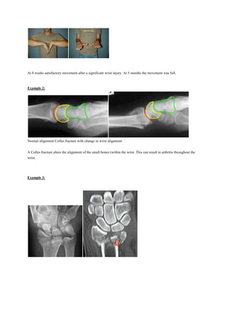 At 8 weeks satisfactory movement after a significant wrist injury. At 5 months the movement was full.
Example 2:
Normal alignment Colles fracture with change in wrist alignment
A Colles fracture alters the alignment of the small bones (within the wrist. This can result in arthritis throughout the
wrist.
Example 3:
 