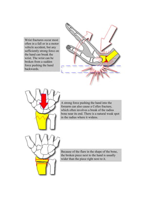 Wrist fractures occur most
often in a fall or in a motor
vehicle accident, but any
sufficiently strong force on
the hand can break the
wrist. The wrist can be
broken from a sudden
force pushing the hand
backwards.
A strong force pushing the hand into the
forearm can also cause a Colles fracture,
which often involves a break of the radius
bone near its end. There is a natural weak spot
in the radius where it widens.
Because of the flare in the shape of the bone,
the broken piece next to the hand is usually
wider than the piece right next to it.
 