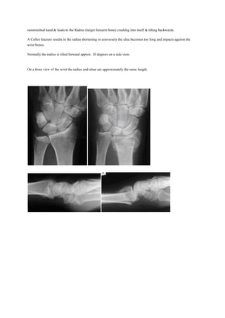 outstretched hand & leads to the Radius (larger forearm bone) crushing into itself & tilting backwards.
A Colles fracture results in the radius shortening or conversely the ulna becomes too long and impacts against the
wrist bones.
Normally the radius is tilted forward approx. 10 degrees on a side view.
On a front view of the wrist the radius and ulnar are approximately the same length.
 