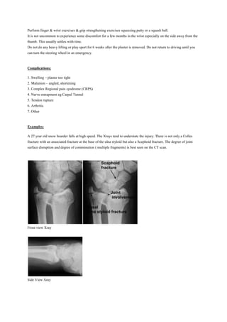 Perform finger & wrist exercises & grip strengthening exercises squeezing putty or a squash ball.
It is not uncommon to experience some discomfort for a few months in the wrist especially on the side away from the
thumb. This usually settles with time.
Do not do any heavy lifting or play sport for 6 weeks after the plaster is removed. Do not return to driving until you
can turn the steering wheel in an emergency.
Complications:
1. Swelling – plaster too tight
2. Malunion – angled, shortening
3. Complex Regional pain syndrome (CRPS)
4. Nerve entrapment eg Carpal Tunnel
5. Tendon rupture
6. Arthritis
7. Other
Examples:
A 27 year old snow boarder falls at high speed. The Xrays tend to understate the injury. There is not only a Colles
fracture with an associated fracture at the base of the ulna styloid but also a Scaphoid fracture. The degree of joint
surface disruption and degree of comminution ( multiple fragments) is best seen on the CT scan.
Front view Xray
Side View Xray
 