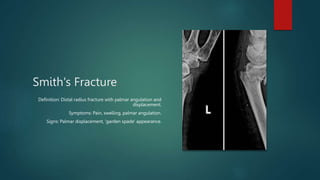 Colles' and Smith's fractures are common distal radius fractures with ...
