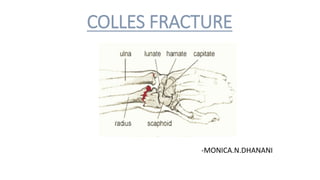 COLLES FRACTURE
-MONICA.N.DHANANI
 