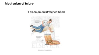Mechanism of Injury-
Fall on an outstretched hand.
 