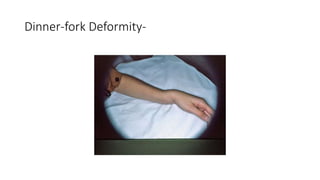 Dinner-fork Deformity-
 