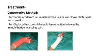 Treatment-
Conservative Method:
For Undisplaced fracture-immobilisation in a below-elbow plaster cast
for six weeks
For Displaced fractures- Manipulative reduction followed by
immobilization in a colles cast.
 