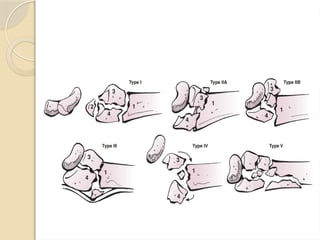 Colles fracture most common of all fractures | PPTX