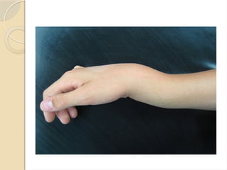 Colles Rosh Colles fracture most common of all fractures | PPTX