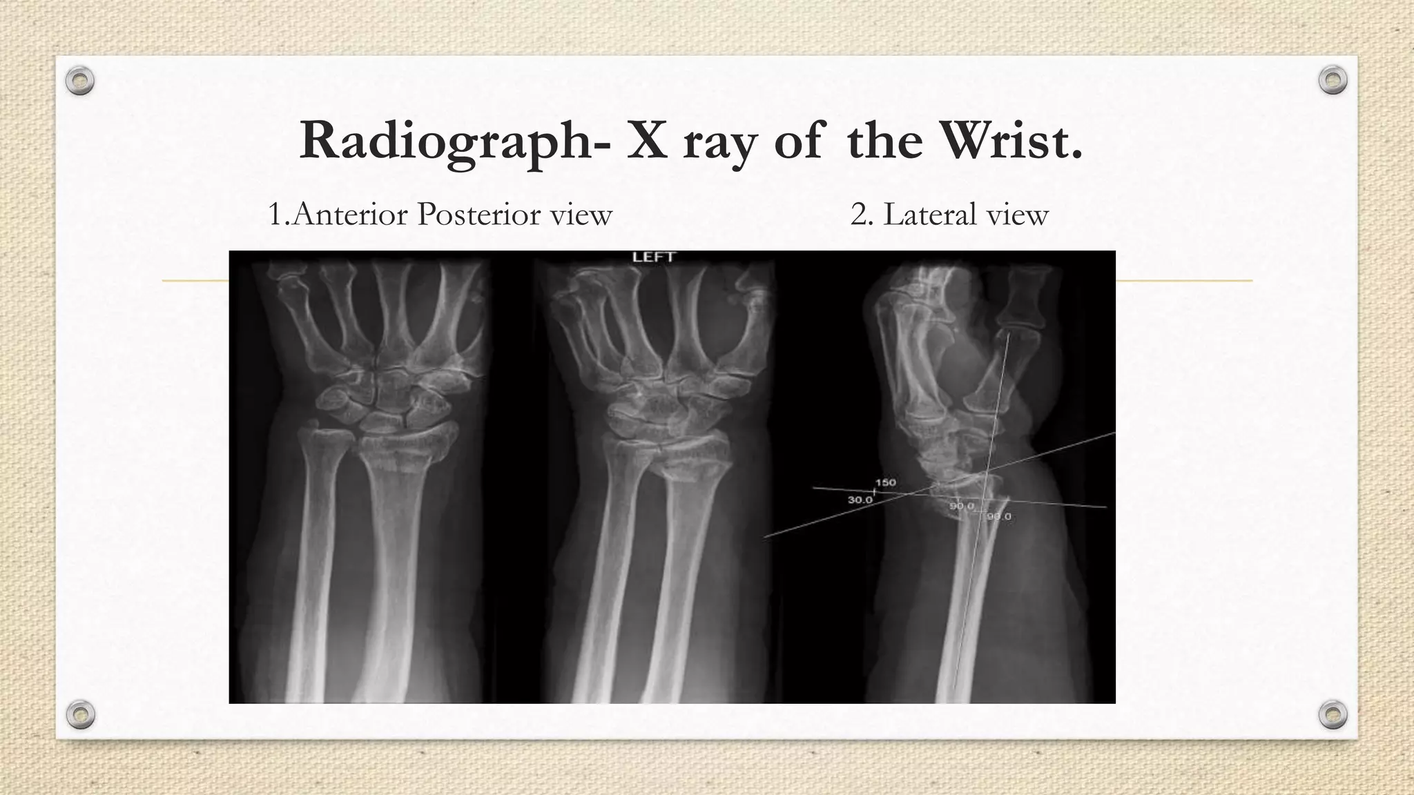 Radiograph- X ray of the Wrist.
1.Anterior Posterior view 2. Lateral view
 