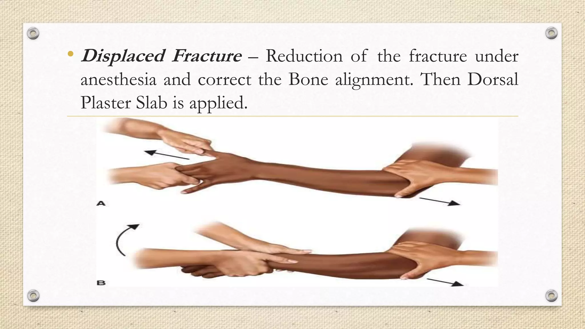 • Displaced Fracture – Reduction of the fracture under
anesthesia and correct the Bone alignment. Then Dorsal
Plaster Slab is applied.
 