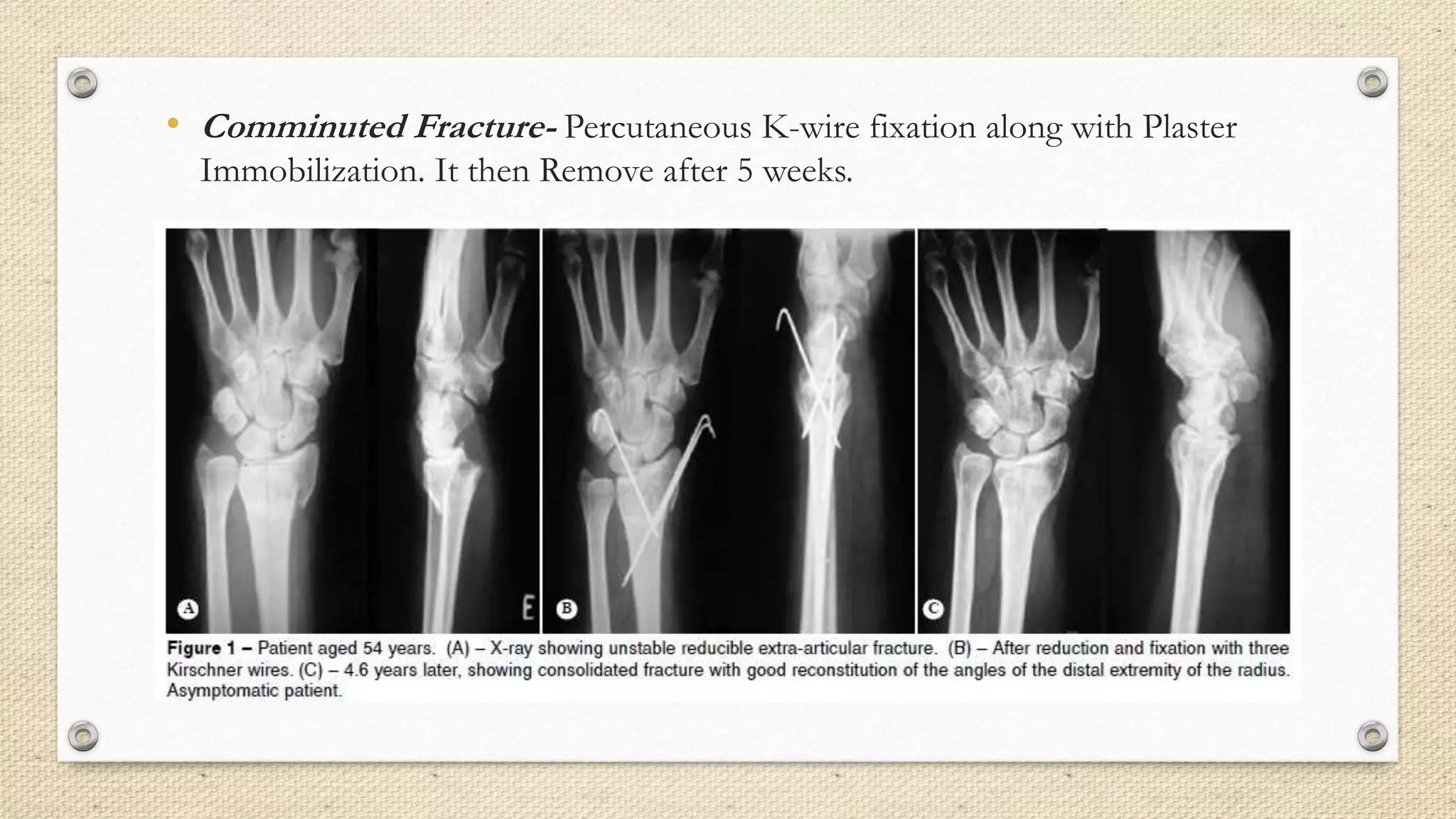 • Comminuted Fracture- Percutaneous K-wire fixation along with Plaster
Immobilization. It then Remove after 5 weeks.
 