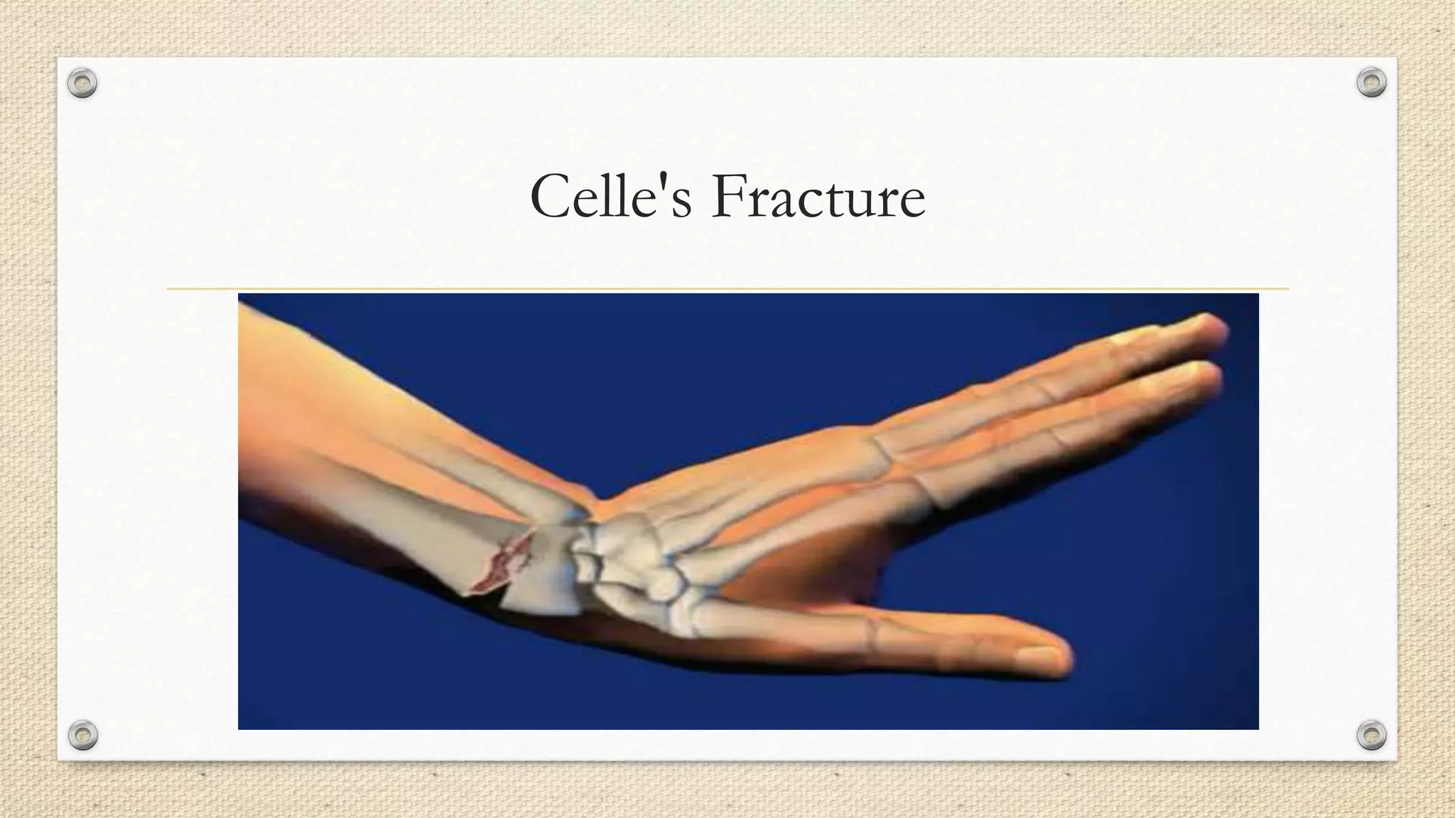 Celle's Fracture
 