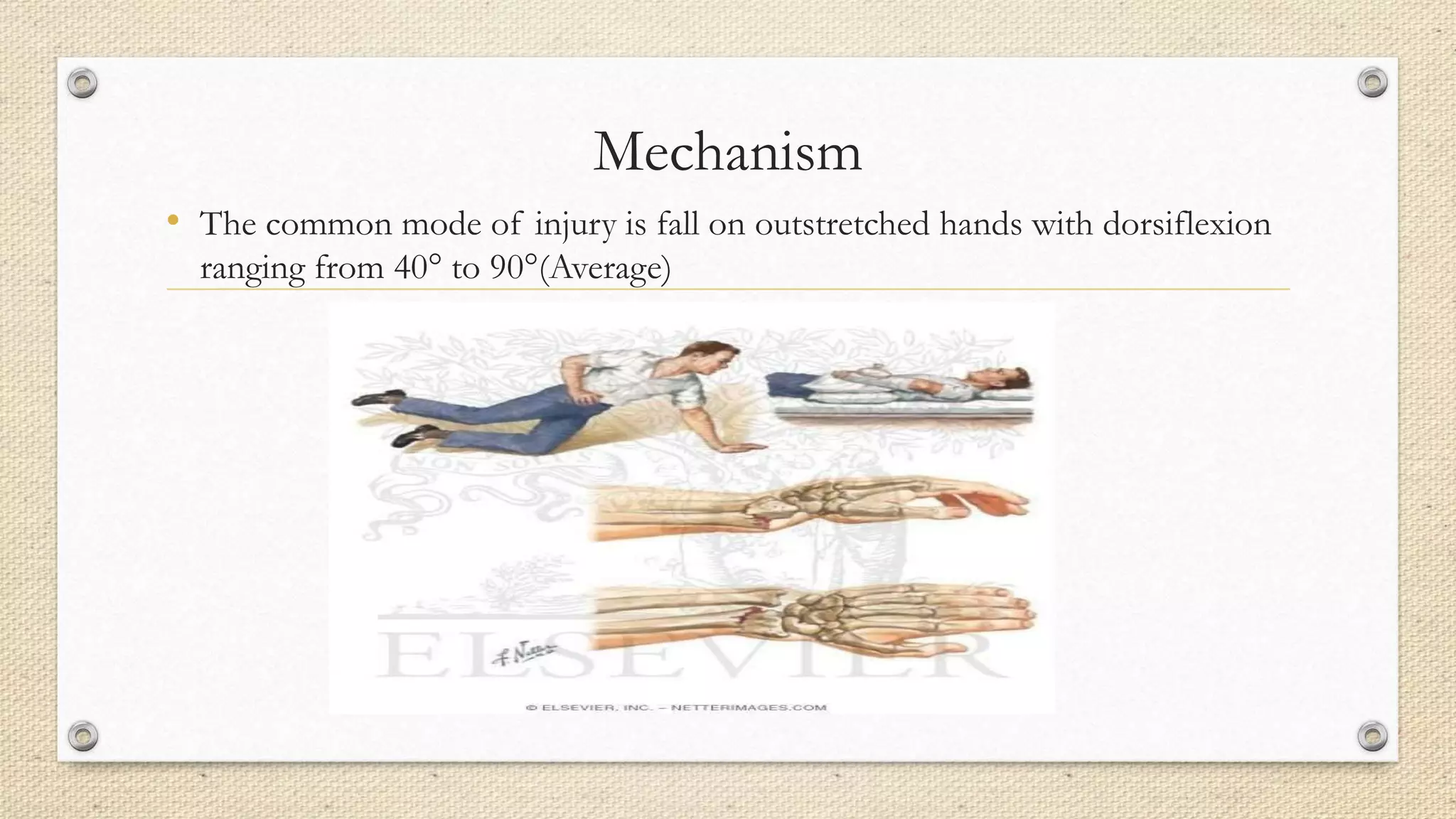 Mechanism
• The common mode of injury is fall on outstretched hands with dorsiflexion
ranging from 40° to 90°(Average)
 