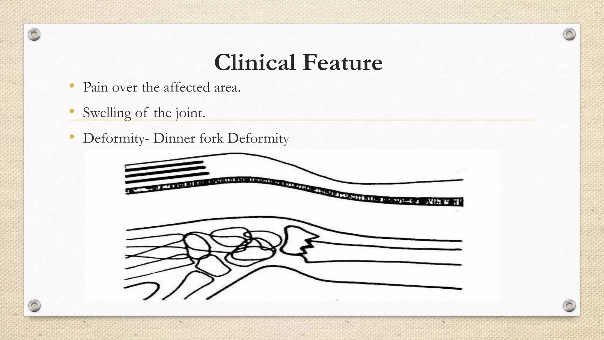 Clinical Feature
• Pain over the affected area.
• Swelling of the joint.
• Deformity- Dinner fork Deformity
 