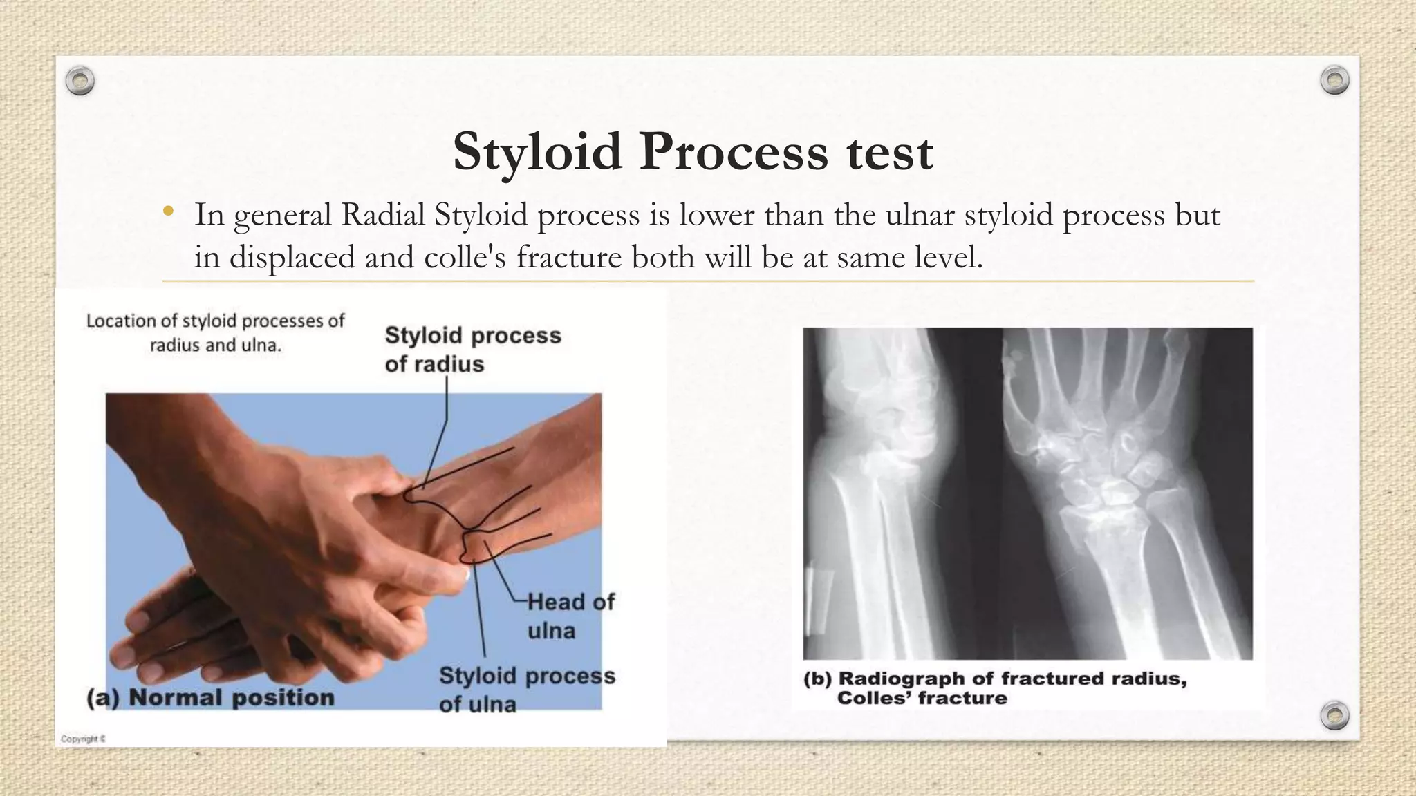 Styloid Process test
• In general Radial Styloid process is lower than the ulnar styloid process but
in displaced and colle's fracture both will be at same level.
 