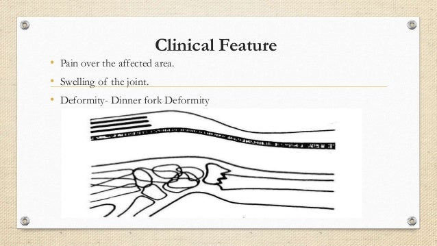 colles smith fracture fork