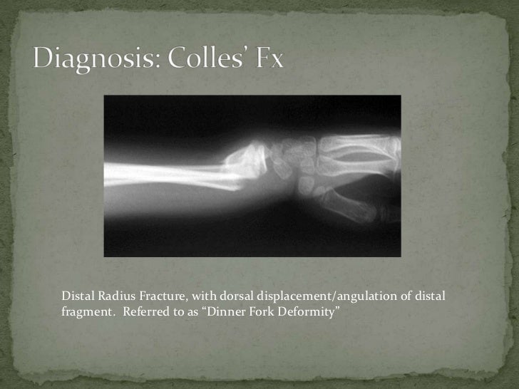 Colles’ fracture (1)