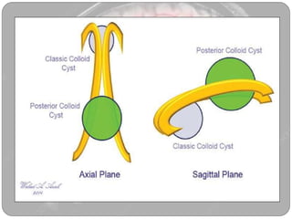 Colloid cyst | PPTX