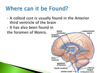  A colloid cyst is usually found in the Anterior
third ventricle of the brain
 It has also been found in
the foramen of Monro.
 