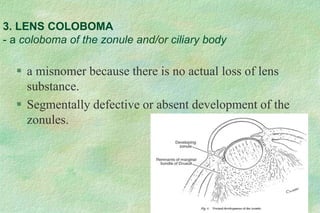 3. LENS COLOBOMA
- a coloboma of the zonule and/or ciliary body
 a misnomer because there is no actual loss of lens
substance.
 Segmentally defective or absent development of the
zonules.
 