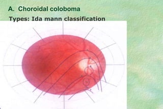 A. Choroidal coloboma
Types: Ida mann classification
 