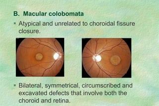  Atypical and unrelated to choroidal fissure
closure.
 Bilateral, symmetrical, circumscribed and
excavated defects that involve both the
choroid and retina.
B. Macular colobomata
 